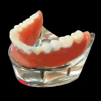 1Pc 4 Dantų Implantų Dantų Studijų Modelį Overdenture Prastesnės Demo Modelis